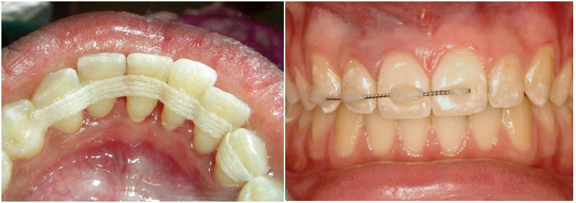 Splinting of Teeth – Dentabode